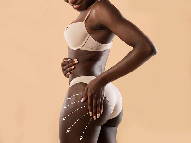 Brazilian Butt Lift in tunisia